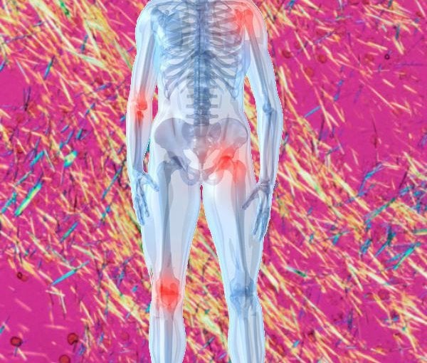 Gouty Uric Acid image