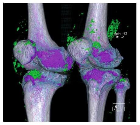 DECT of Gout in the Knees