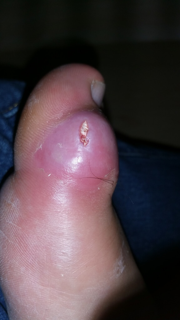 Burst Tophi on Big Toe photo