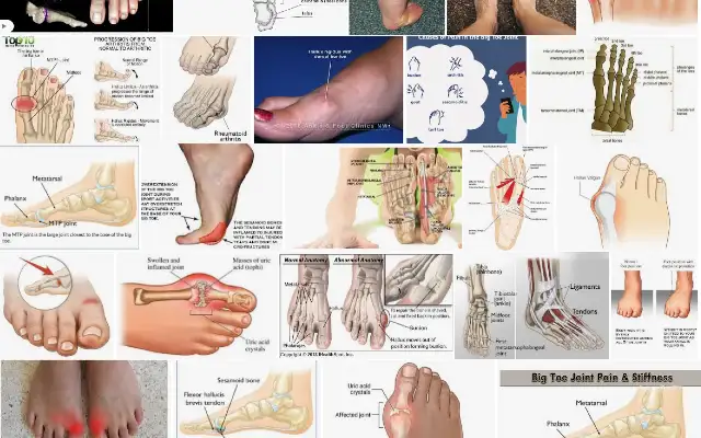 How does Gout affect Your Big Toe Joint?